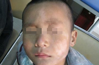 武汉北大白癜风医院医生提示小孩脸上白癜风怎么治疗
