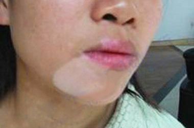 武汉北大白癜风医院医生提示脸部白癜风患者怎样洗脸