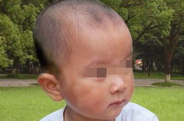 武汉北大白癜风医院医生表示小孩患上白癜风该怎么办