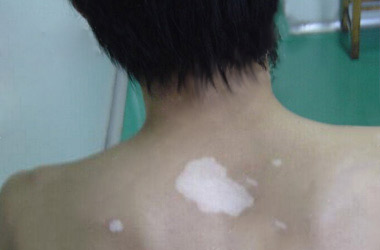 武汉北大白癜风医院医生讲述为什么背部会患白癜风