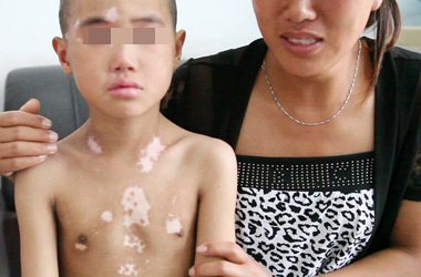 武汉北大白癜风医院医生介绍儿童白癜风的发病症状