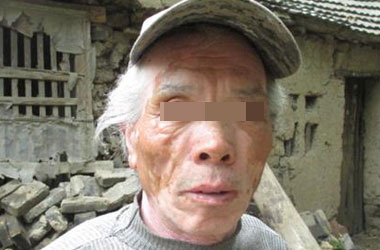 武汉北大白癜风医院医生介绍老年斑与白癜风如何区分