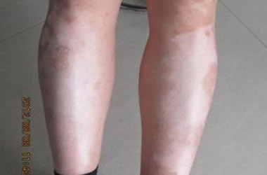 武汉北大白癜风医院医生介绍腿部出现白斑要怎么治疗