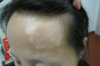 武汉女性白癜风患者在化妆时需要注意的事项