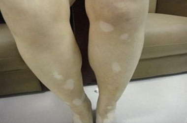 武汉北大白癜风医院医生介绍肢端型白癜风的并发症状