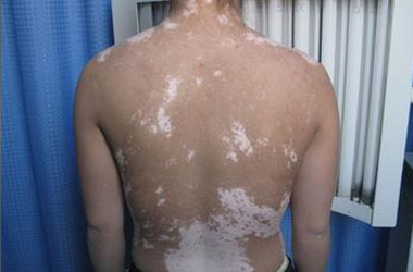 武汉北大白癜风医院医生介绍背部白癜风早期的症状