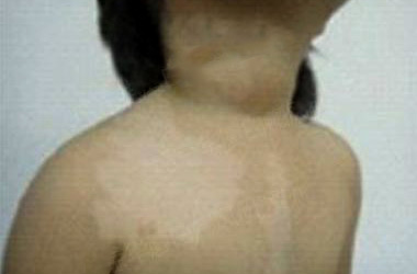 武汉北大白癜风医院医生介绍孩子身上长白斑的原因