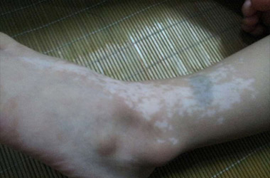 武汉北大白癜风医院医生介绍腿部白癜风的初期症状
