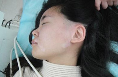 武汉北大白癜风医院医生介绍白癜风疾病的发病原因