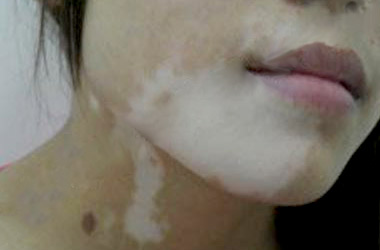 武汉北大白癜风医院介绍女性白癜风患者化妆会有什么危害