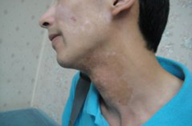 武汉北大白癜风医院医生介绍脖子上的白癜风怎么治疗