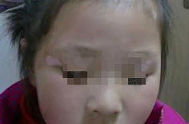 武汉北大白癜风医院医生介绍小孩出现白癜风的原因