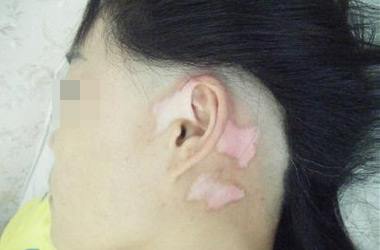 武汉女性白癜风患者护肤的注意事项有哪些?