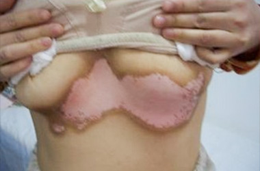 武汉治疗女性胸部白癜风需要注意什么？