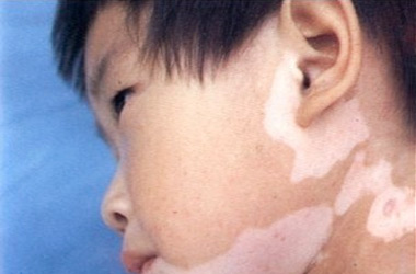武汉北大白癜风医院介绍儿童白癜风常见病因
