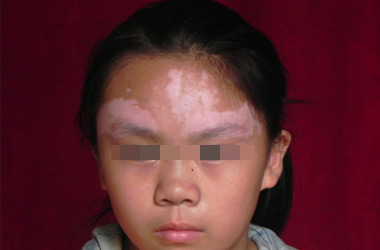 武汉北大白癜风医院介绍哪些因素会导致儿童患上白癜风呢?