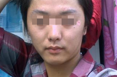 武汉16岁孩子脸上长白癜风该怎么治疗呢?