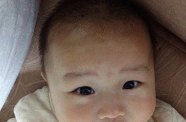 武汉小宝宝患上白癜风该如何护理呢?