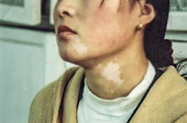 武汉患者颈部有了白癜风该如何治疗好?