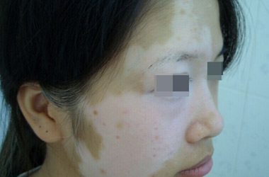 武汉白癜风医院介绍脸部大块白斑到底是什么病?